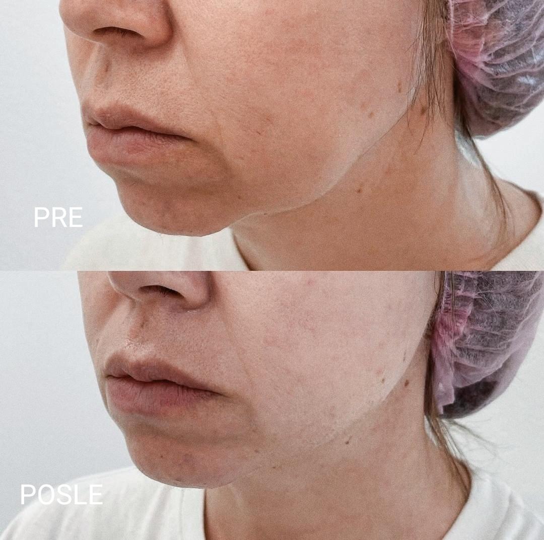 AmiSo Beauty Studio #novisad Masaža za parove Lifting masaža lica (skulpturalna + bukalna) vratno-ramena zonа + maska za lice Holy Land