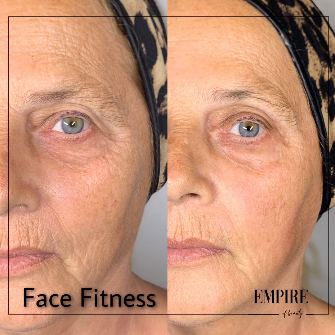Guardian Beauty Centar & Milica Tepavac #beograd Tretmani protiv bora Face fitness - antiage trening lica