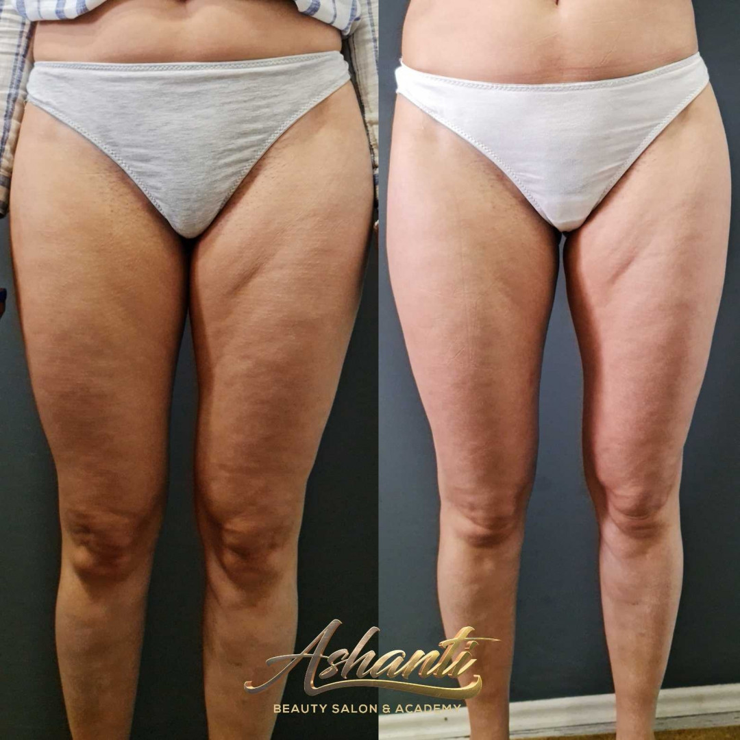 Ashanti Beauty Salon & Academy #beograd Masaža za mršavljenje Premijum maderoterapija