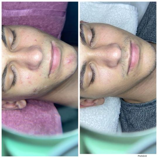 Bjanka Skin Studio #beograd Tretman lica Tretman problematične kože - za muškarce Lice
