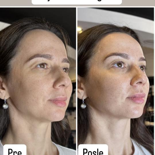 Petra beauty concept #beograd Tretman lica Orijent lifting tretman Orijent kift je tehnika koja obuh