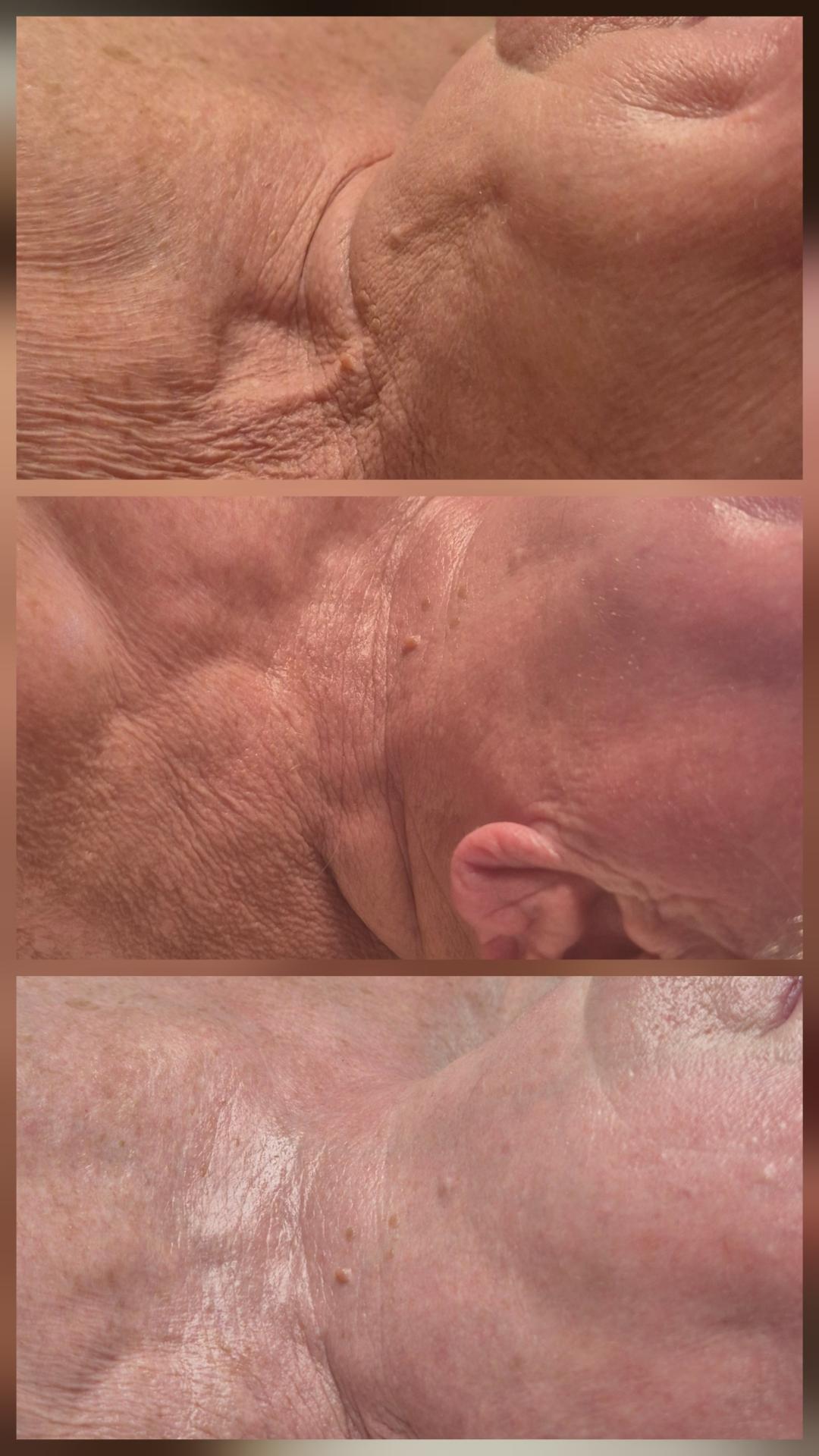 Skulpturalni face lifting - Bellavana studio, Kruševac Lifting / zatezanje kože Lice Lifting / zatezanje kože, Kruševac, Centar
