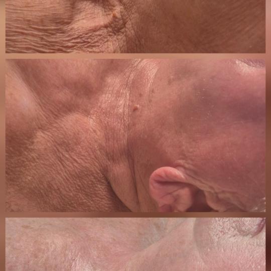 Bellavana studio #krusevac Lifting / zatezanje kože Skulpturalni face lifting