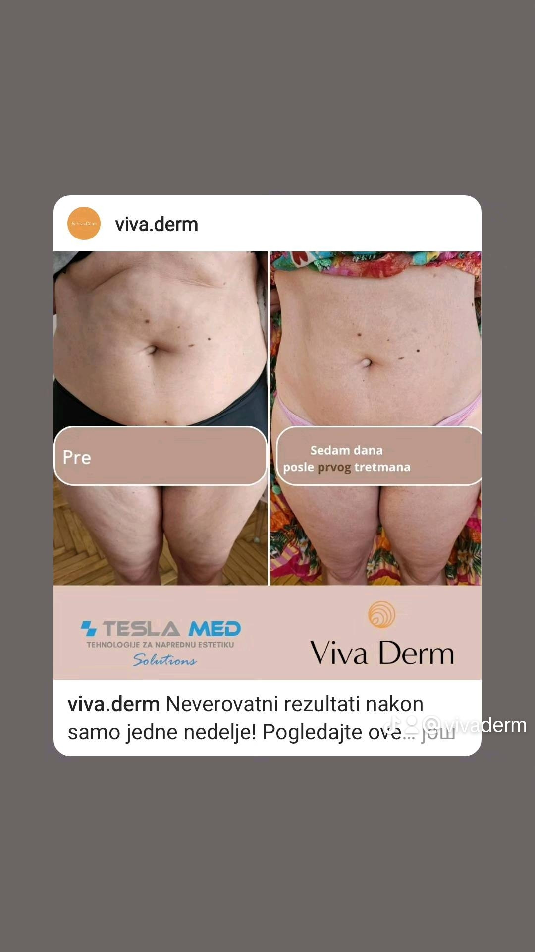 Viva Derm #beograd Tretmani tela Tesla MED - Dermaresurface (uklanjanje celulita)