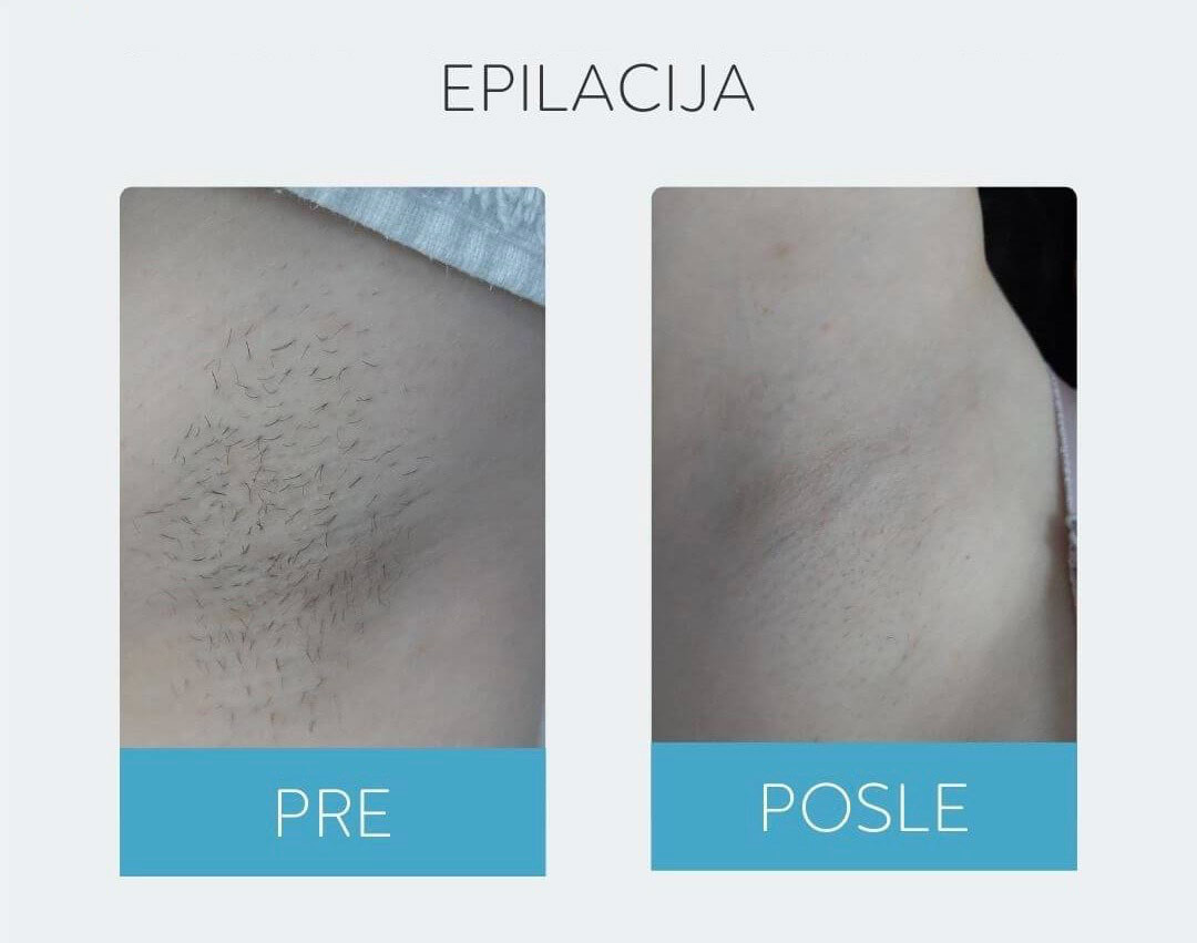 DepilConcept #beograd