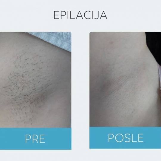 DepilConcept #beograd