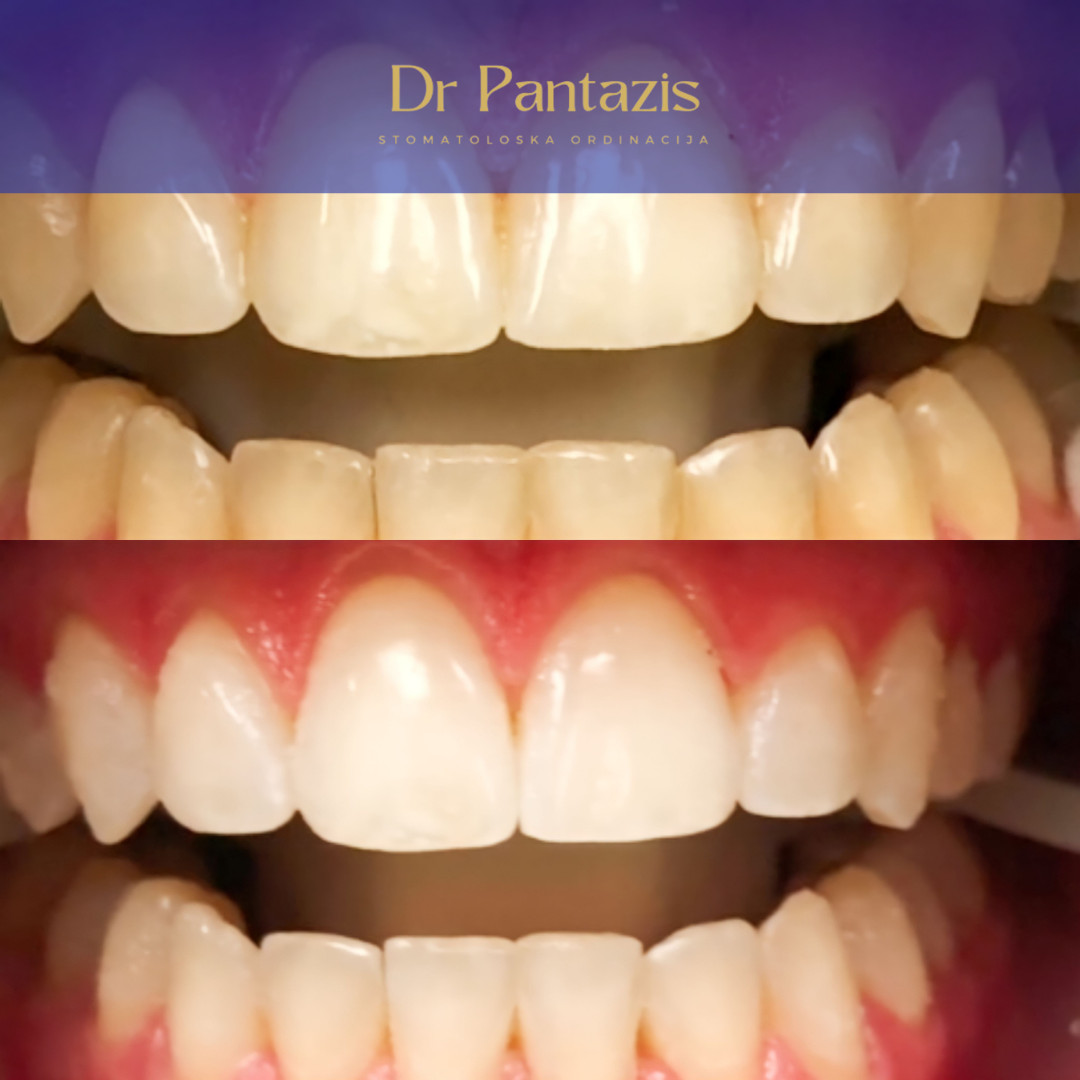 Dr Pantazis - Dental & Beauty Clinic #beograd Zubi Lasersko Profesionalno Izbeljivanje Zuba
