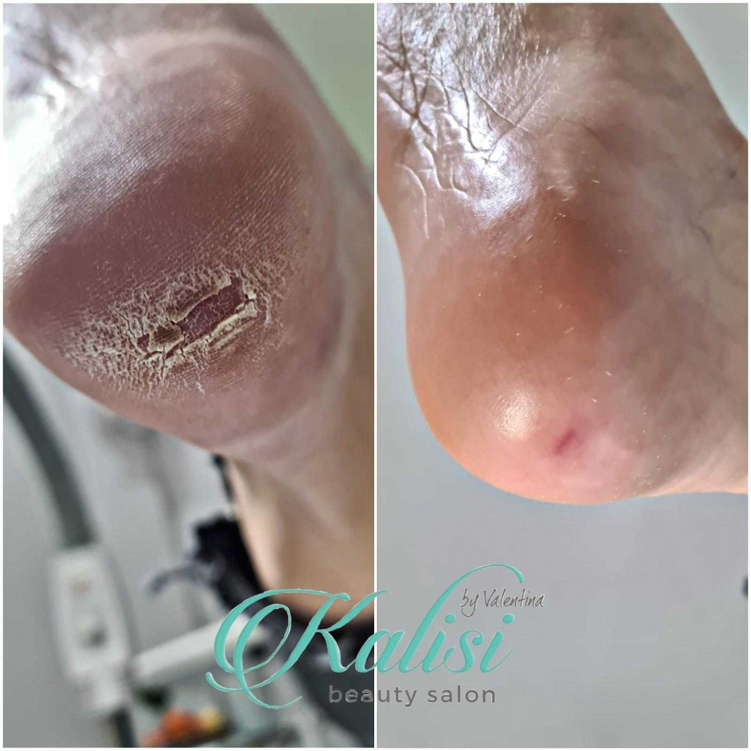 Kalisi #beograd Estetski pedikir Aparatni pedikir