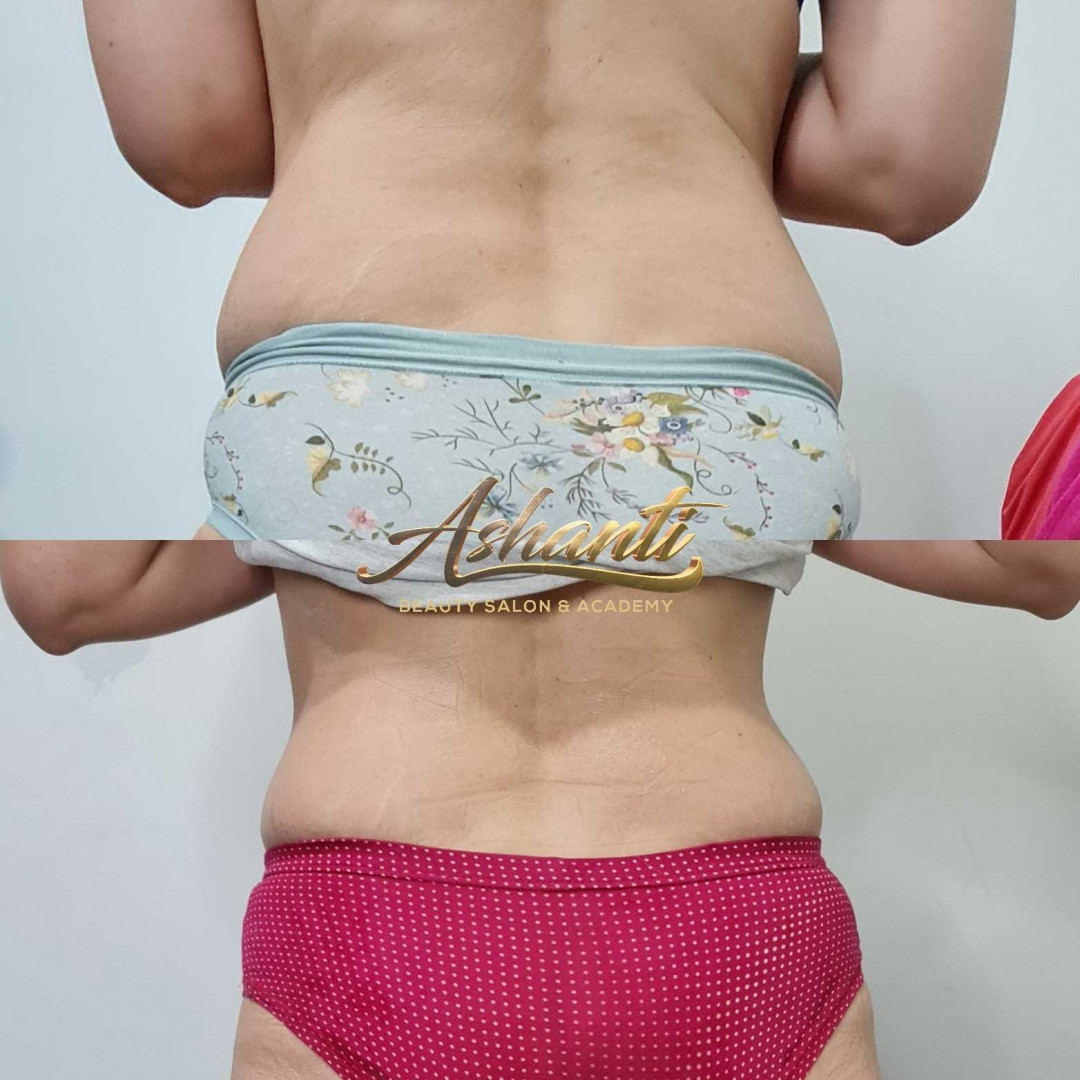 Ashanti Beauty Salon & Academy #beograd Tretmani za mršavljenje Vacuslim 48 - noge + stomak