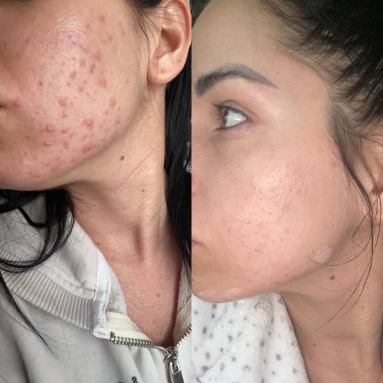 Beauty and nutrition #beograd Dermaroler i dermapen DERMAPEN TRETMAN 
PRE/POSLE 

Dermapen mezote