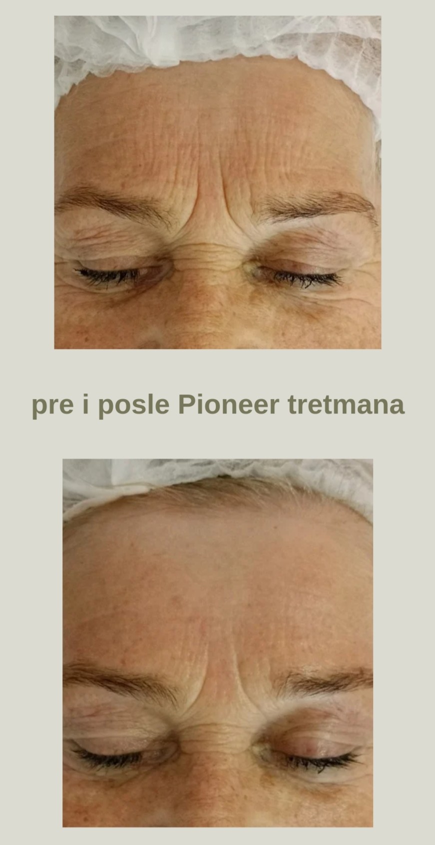 Bloom #sremska-mitrovica Tretman lica Pioneer - premium tretman podmlađivanja (bore i čvrstina)
