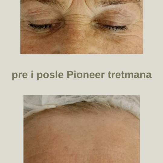 Bloom #sremska-mitrovica Tretman lica Pioneer - premium tretman podmlađivanja (bore i čvrstina)