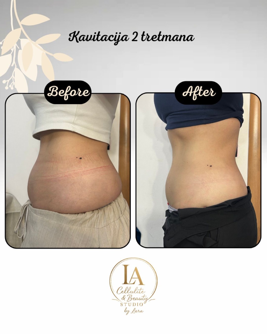Lara Beauty 037 #krusevac Kavitacija Kavitacija