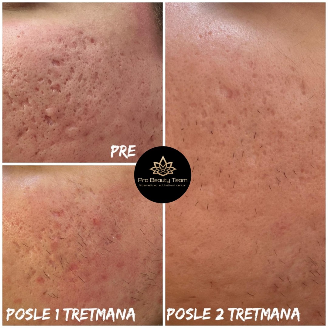 Pro Beauty Team #beograd Tretman lica Voćne kiseline + dermapen