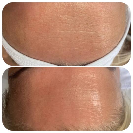 Prestige #beograd Tretman lica Biorevitalizacija lica