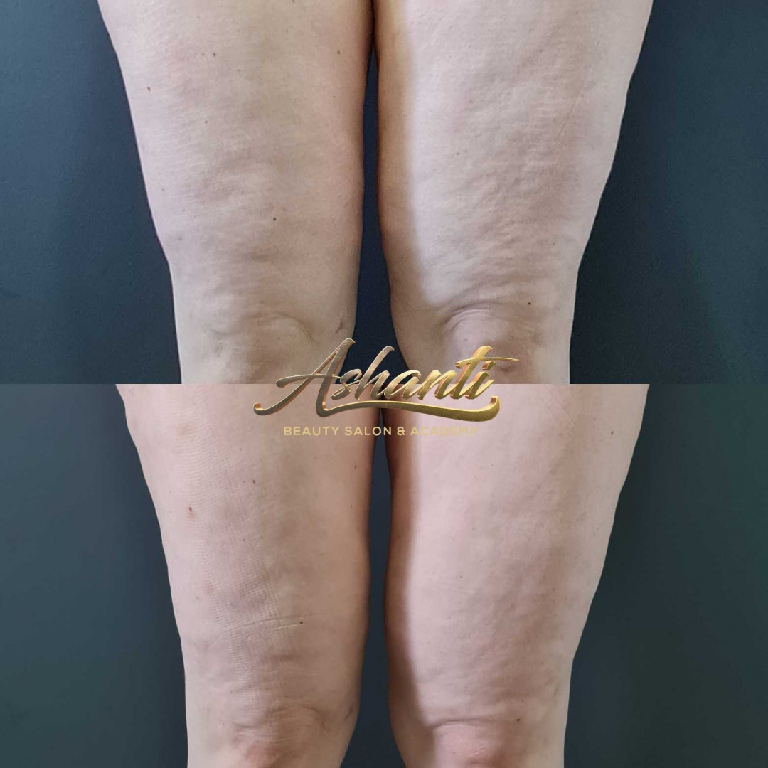 Ashanti Beauty Salon & Academy #beograd Masaža za mršavljenje Dermapen - regija lica