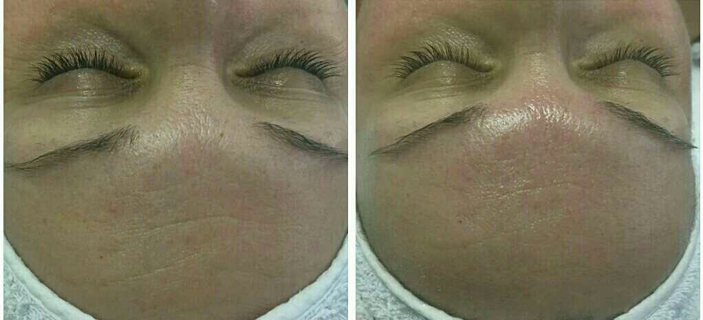 Look at me #beograd Tretmani protiv bora 3D Wrinkle tretman lica