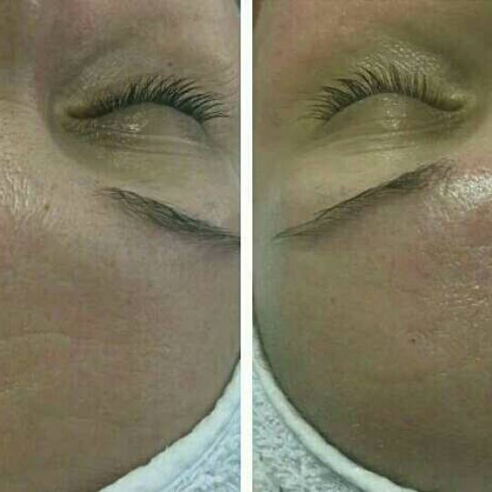 Look at me #beograd Tretmani protiv bora 3D Wrinkle tretman lica