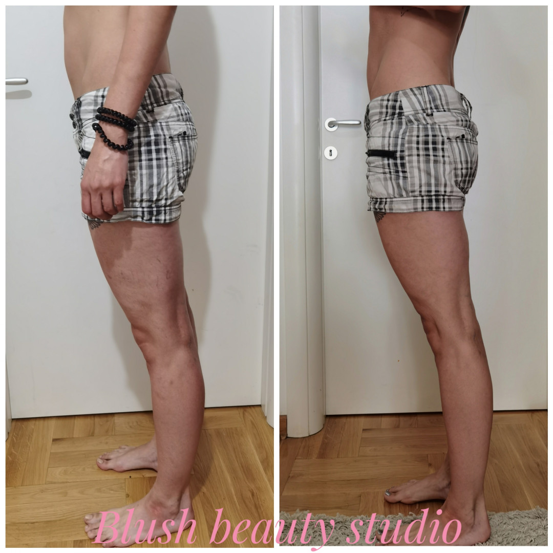 Blush Beauty Studio #beograd Anticelulit masaža Anticelulit masaža 45 minuta - paket od 10 tretmana