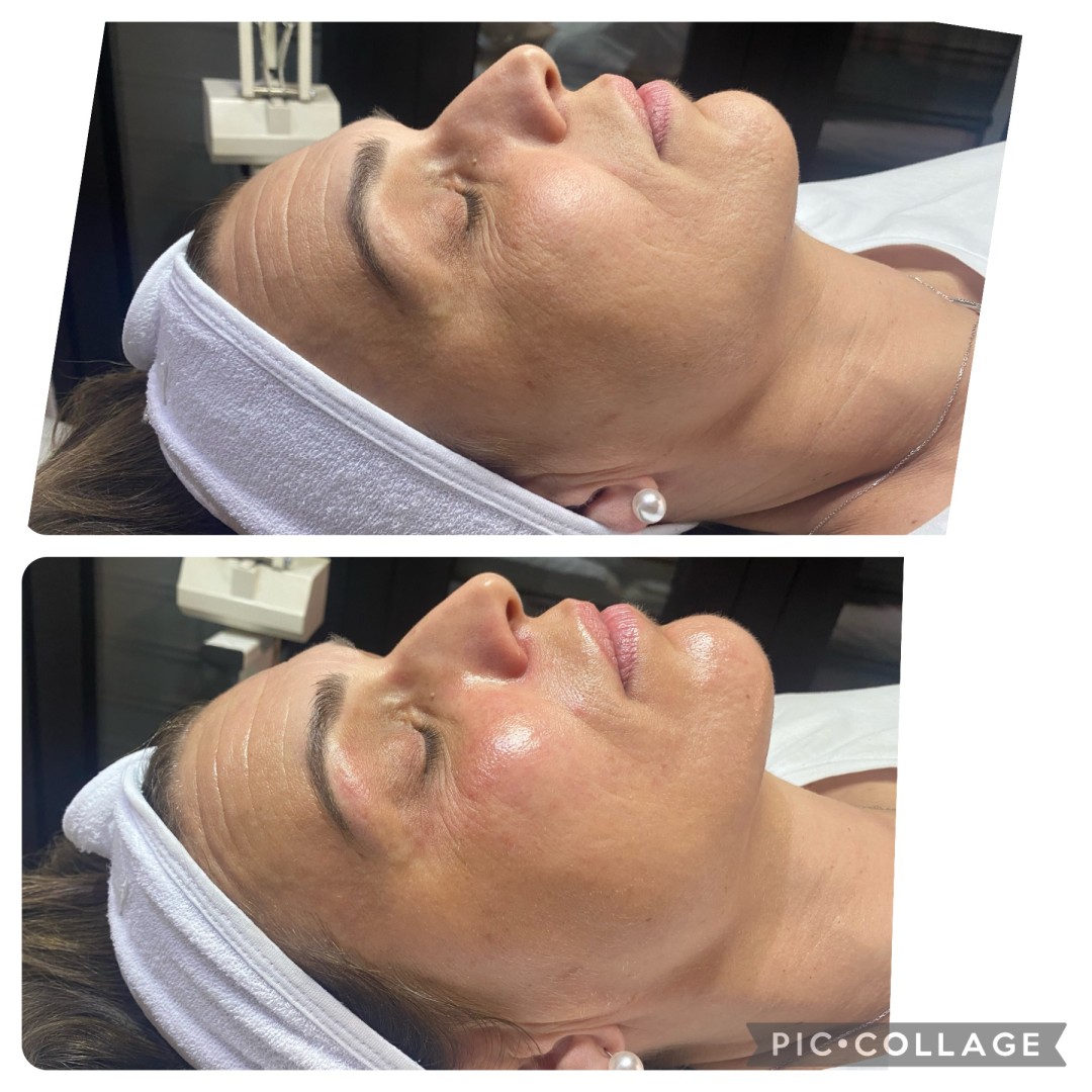 Prestige #beograd Tretman lica Circadia - SWICH DERMAL REJUVENATION SYSTEM TREATMENT