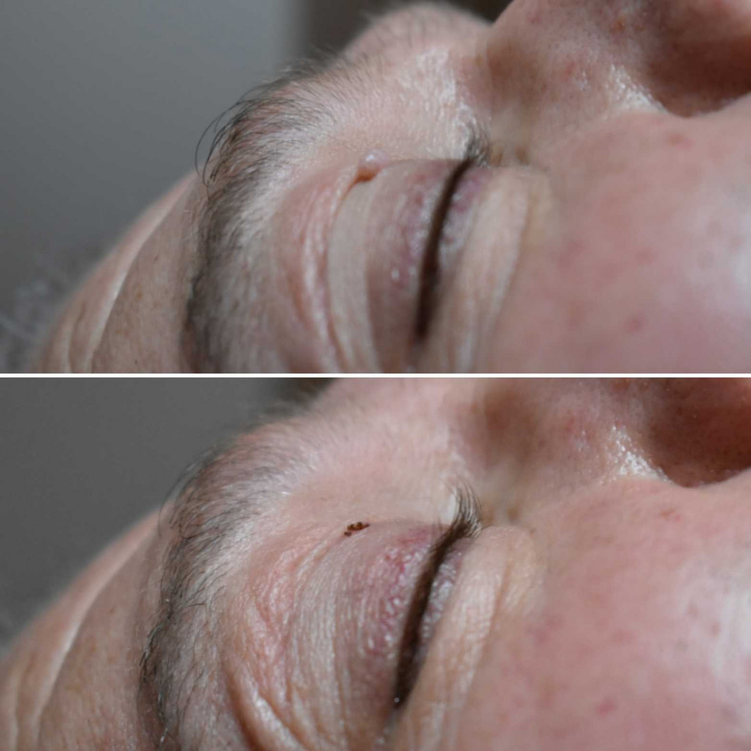 Beauty fit #beograd Tretmani tela Uklanjanje bradavica