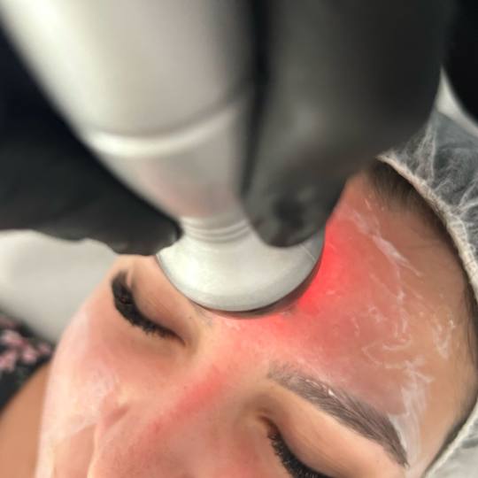 Esthetique Privé #beograd Tretman lica Radiotalasni lifting lica + vrata