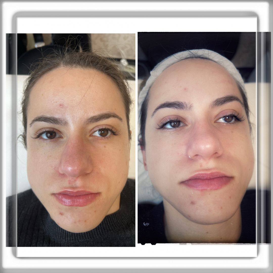 Step up beauty #beograd Tretman lica Hidro facial tretman