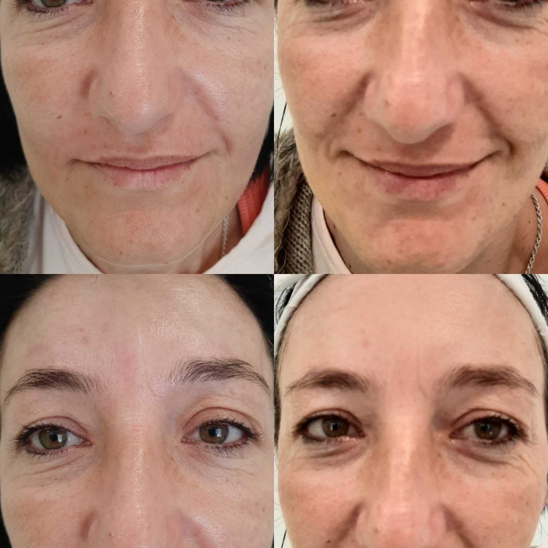 Olja Beauty #beograd Lifting / zatezanje kože HiFu tretman lica - po regiji