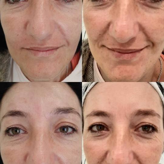 Olja Beauty #beograd Lifting / zatezanje kože HiFu tretman lica - po regiji 3D HIFU nehirusko zatez