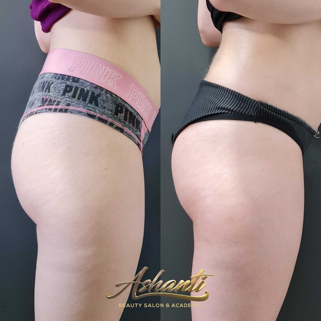 Ashanti Beauty Salon & Academy #beograd Masaža za mršavljenje Dermapen - regija lica