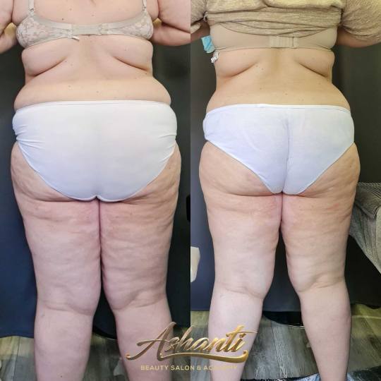 Ashanti Beauty Salon & Academy #beograd Tretmani za mršavljenje Vacuslim 48 - noge + stomak + ruke 