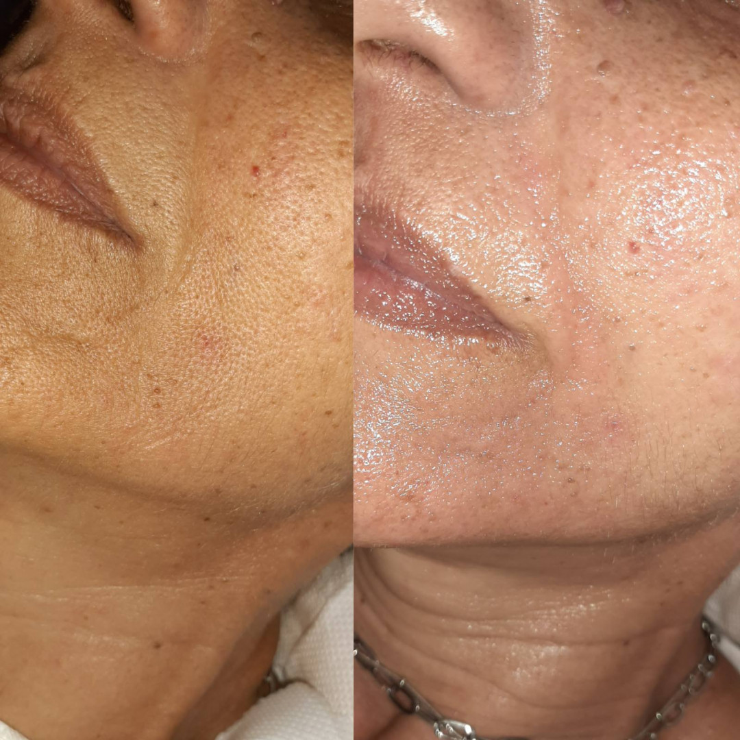 Elin Sary Mary Kutak #beograd Medicinski pedikir Derma Fix tretman lica sa kolagenskim nitima