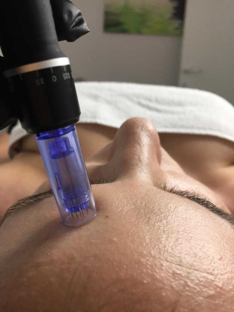 Sensus #beograd Dermaroler i dermapen Dermapen + serum - za biorevitalizaciju