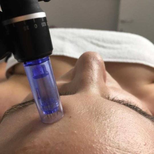 Sensus #beograd Dermaroler i dermapen Dermapen + serum - za biorevitalizaciju