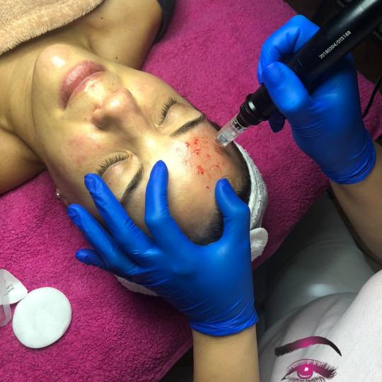 Platinum Beauty Code #beograd Tretman lica Dermapen tretman mezoterapije
Biorevitalizacija Mezopera