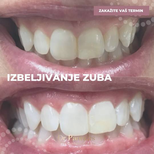 Dr Pantazis - Dental & Beauty Clinic #beograd Zubi Lasersko Profesionalno Izbeljivanje Zuba