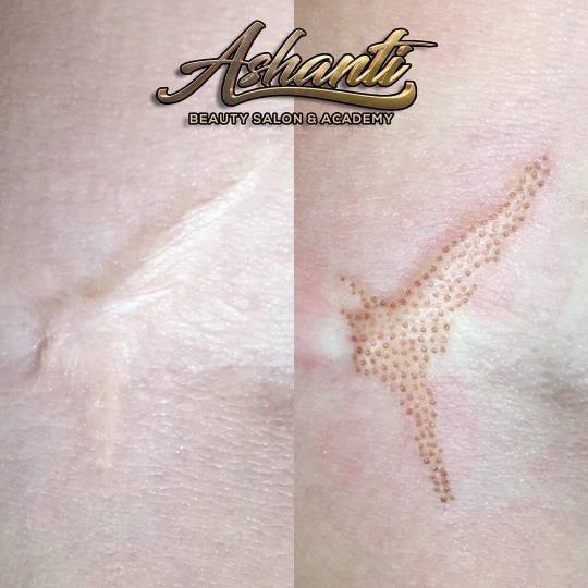 Ashanti Beauty Salon & Academy #beograd Tretman lica Plasma pen - tretiranje ožiljaka