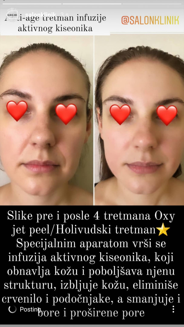 Salon Klinik #beograd Radiotalasni i ultrazvučni tretmani OXI jet peel - tretman lica + ultarzvučna špatula