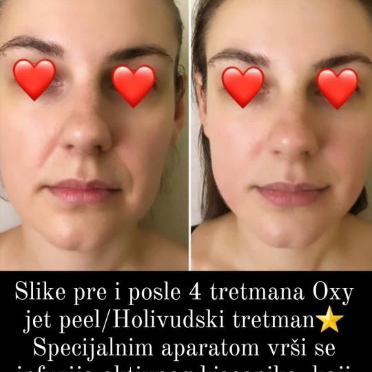 Salon Klinik #beograd Radiotalasni i ultrazvučni tretmani OXI jet peel - tretman lica + ultarzvučn