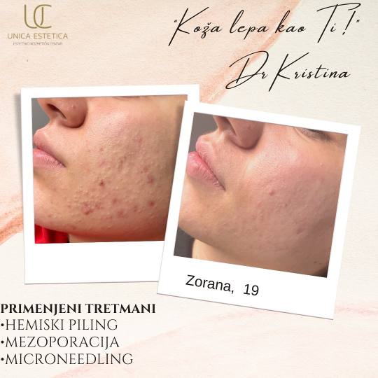 Unica Estetica #nis Tretman lica Microneedling tretman akni 👉🏼Kod drage Zoke, krenule smo dubi