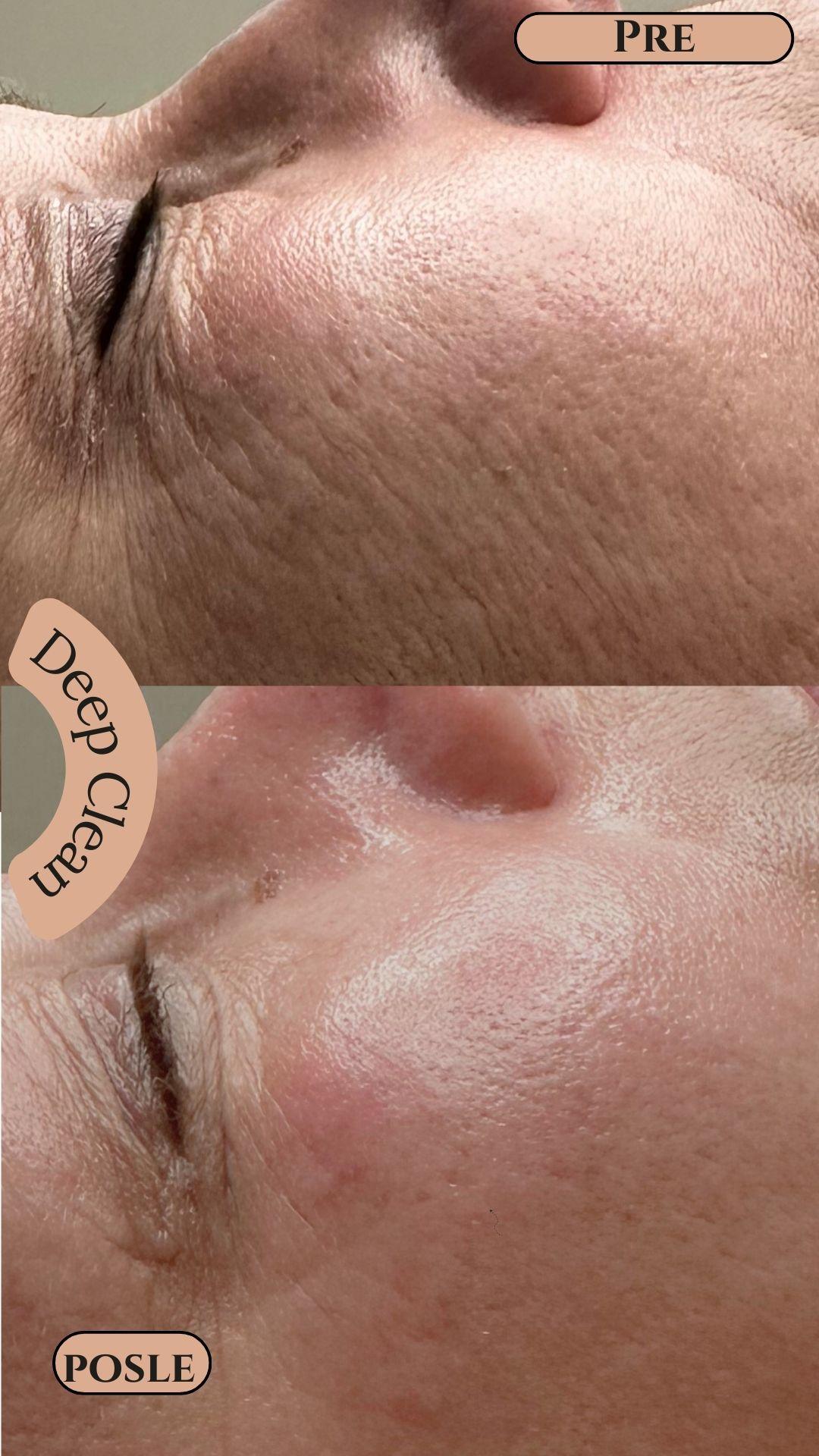 Deep Clean - higijenski tretman+ hydrafacial + UV špatula - Zen Club, Beograd Tretman lica Lice Tretman lica, Beograd, Vidikovac, Petlovo brdo, Labudovo brdo