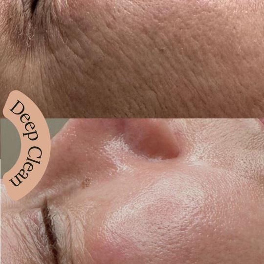 Zen Club #beograd Tretman lica Deep Clean - higijenski tretman+ hydrafacial + UV špatula Tretman ko