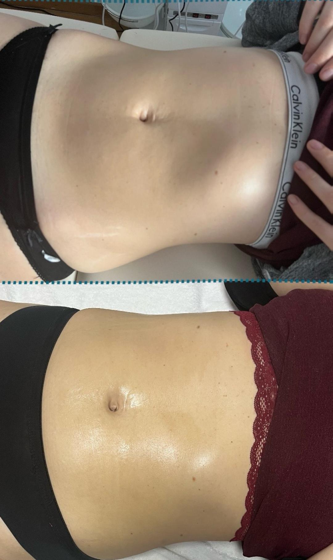 Kavitacija 30min+masaza lipomodelovanje jedne regije - Diamond beauty, Beograd Anticelulit masaža Masaža Anticelulit masaža, Beograd, Zemun Centar