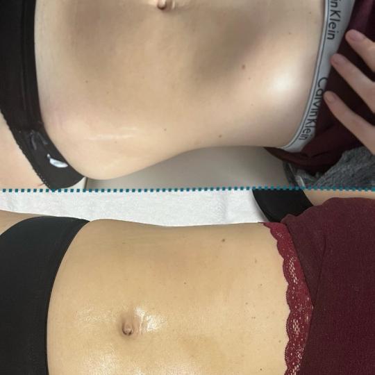 Diamond beauty #beograd Anticelulit masaža Kavitacija 30min+masaza lipomodelovanje jedne regije