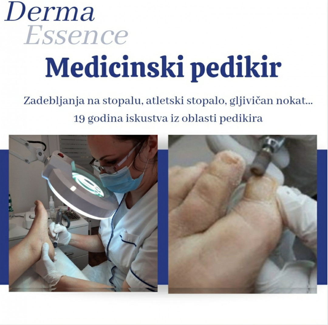 Derma Essence #nis Medicinski pedikir Kompleksni medicinski pedikir