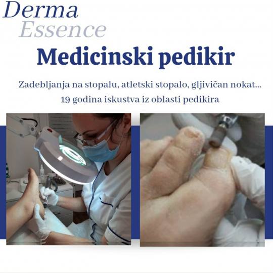 Derma Essence #nis Medicinski pedikir Kompleksni medicinski pedikir Medicinski pedikir: gljivični n