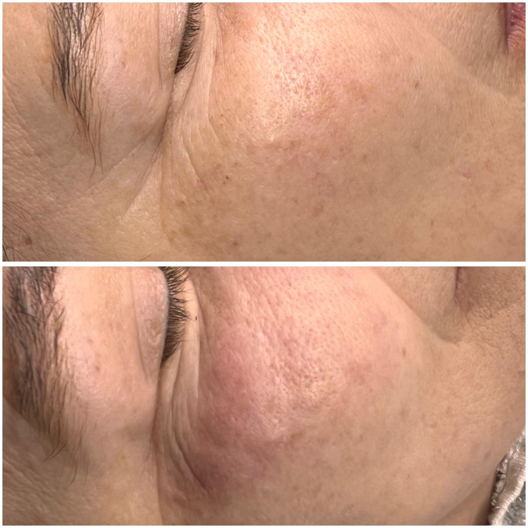 Belle Ana #beograd Tretman lica Microneedling tretman - lice