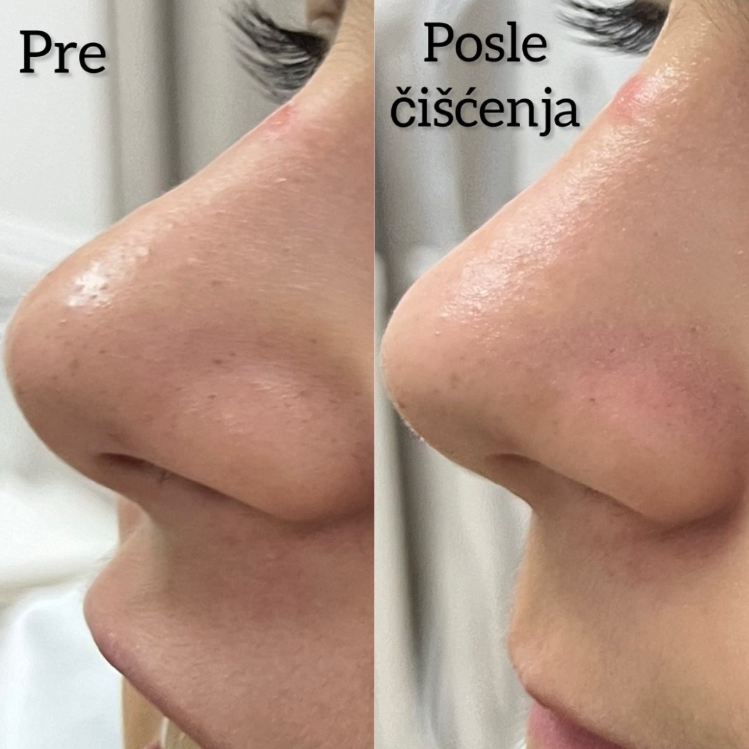 Estetski centar Vlahović #beograd Tretman lica Čišćenje lica ( akne, bubuljice ) - 75 minuta