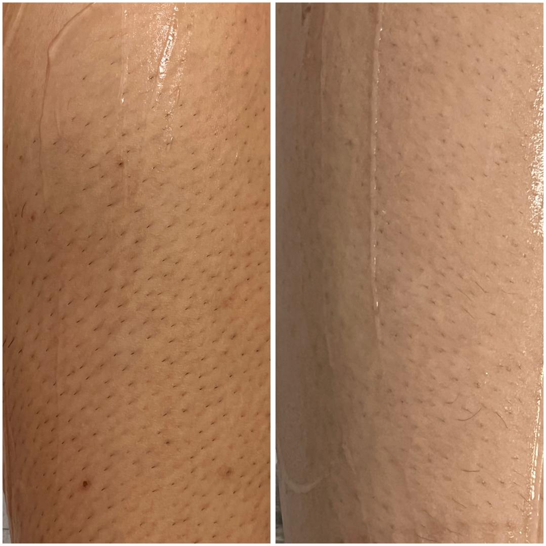 Belle Ana #beograd Laserska epilacija Laserska epilacija celih nogu - za dame