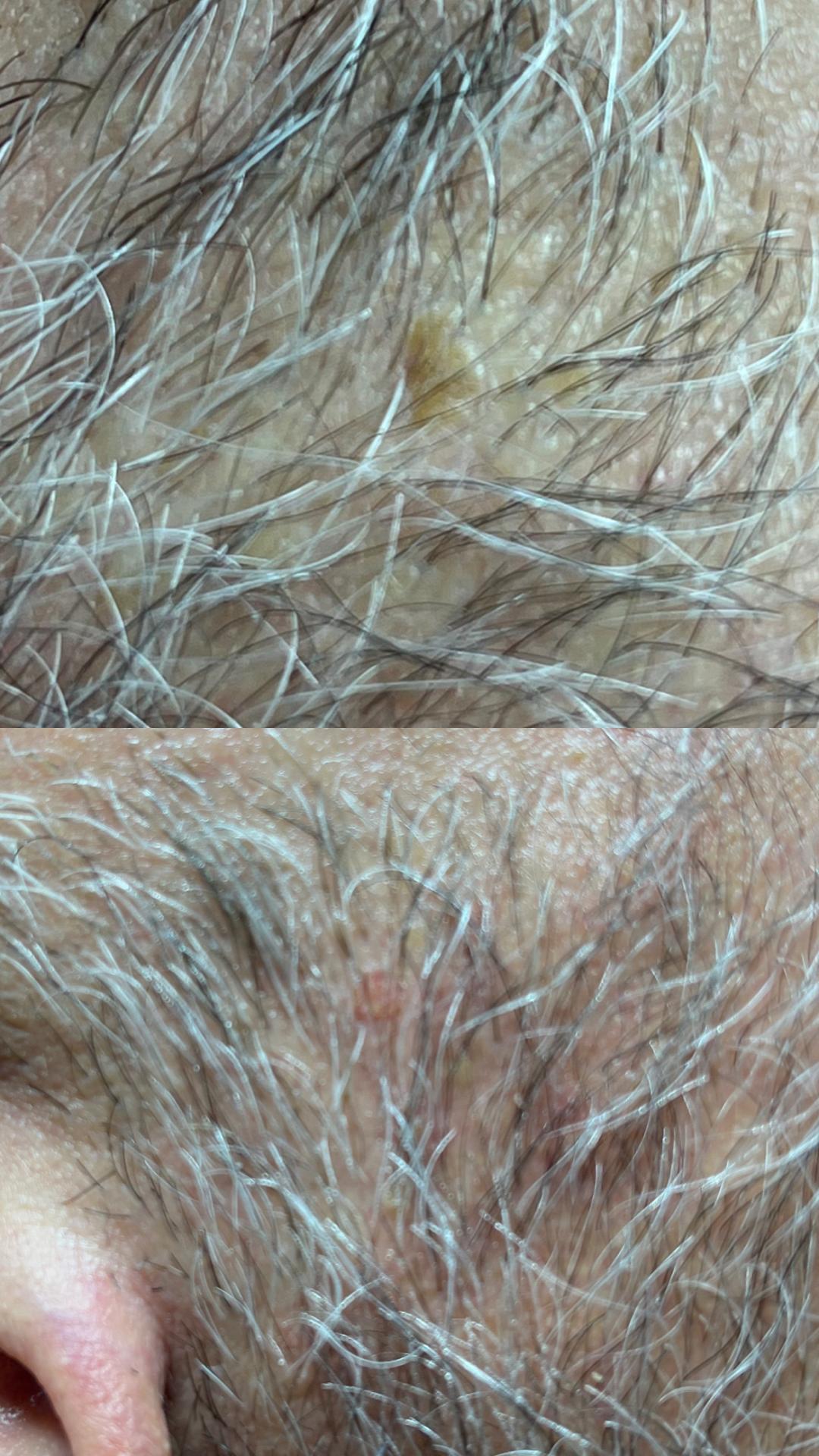 Belle Ana #beograd Tretman lica Phi-Ion tretman - bradavice / papilomi / keratoze / milije / hiperpigmentacija